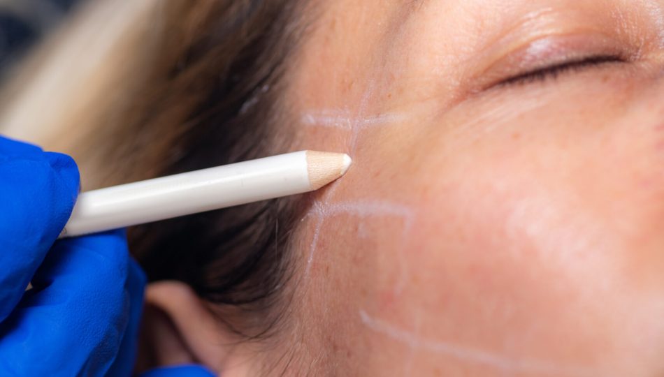 3D Meso Threads for Face Lifting and Contouring. Aesthetic Medicine Concept.