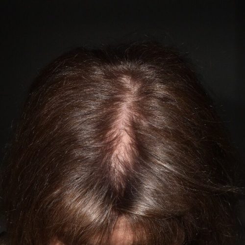 antes Caso capilar fortalecimento e crescimento