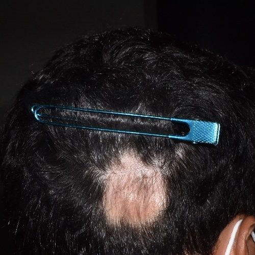 antes Caso pelada
