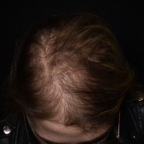 antes caso cabelo alopecia androgenetica