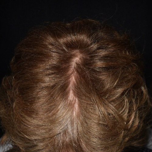 depois Caso capilar fortalecimento e crescimento