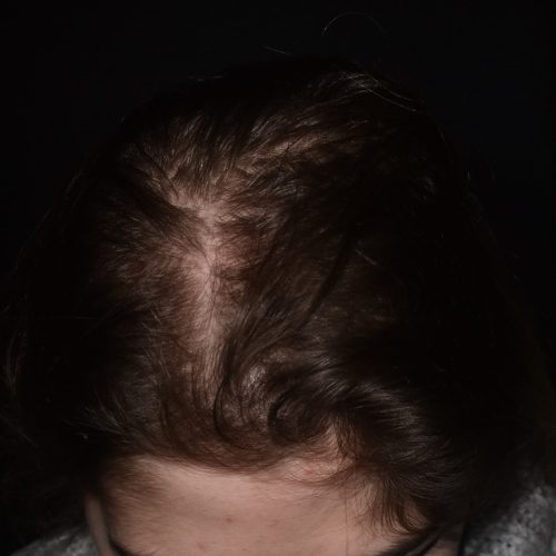 depois - caso cabelo alopecia androgenetica