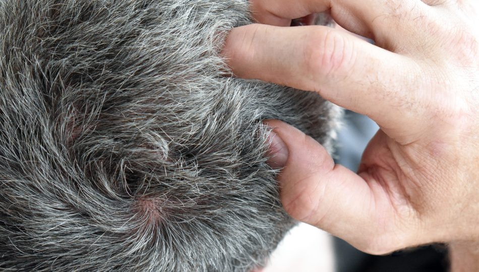 scalp folliculitis